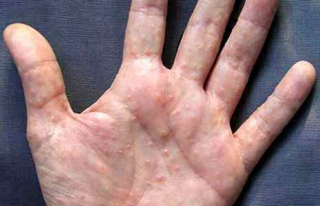Дисгидроз кистей рук у детей лечение