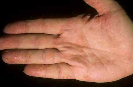 Дисгидроз кистей рук у детей лечение
