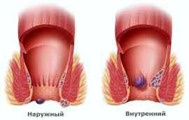 Геморрой у ребенка 3 лет