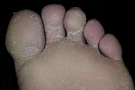 Лечение грибка ногтей на ногах у детей