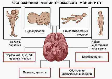 Симптомы заболевания менингитом у детей
