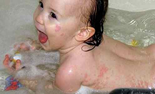 Герпес на носу у ребенка фото