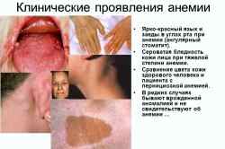 Гипохромная анемия у детей симптомы и лечение