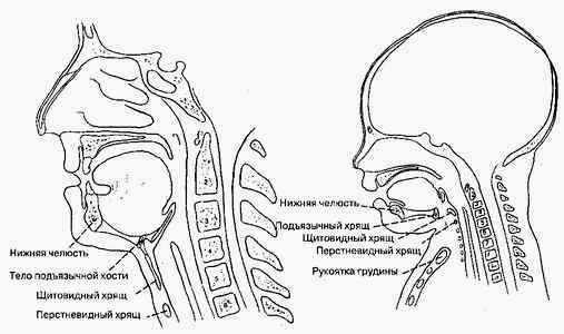 Лечение при стенозе гортани у детей