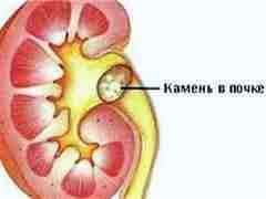 Мочекаменная болезнь у детей реферат