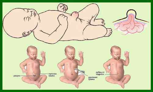 Пупочная грыжа у новорожденного ребенка