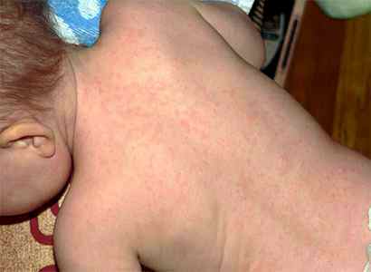 Вирус герпеса 6 типа у детей