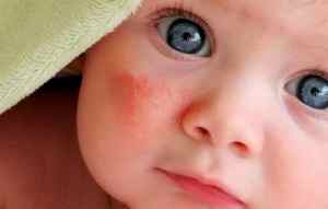 Диатез у ребенка 8 месяцев как лечить