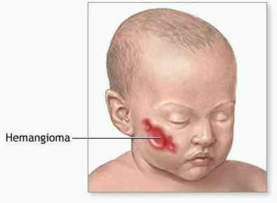 Лечение гемангиомы лазером у детей