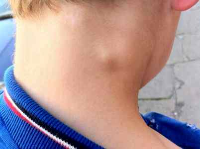 Почему у ребенка увеличены лимфоузлы на голове