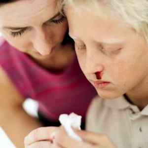 Частые носовые кровотечения у детей причины