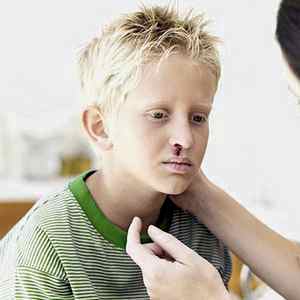 Частые носовые кровотечения у детей причины