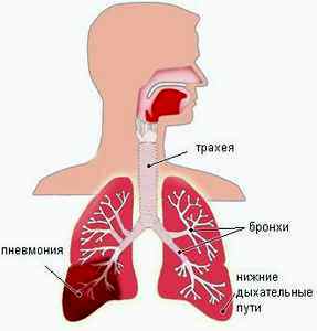 Крупозная пневмония у детей клиника