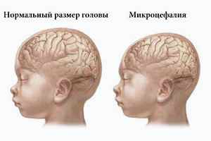 Микроцефалия у детей прогноз