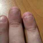 Псориаз ногтей у детей лечение