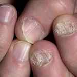 Псориаз ногтей у детей лечение