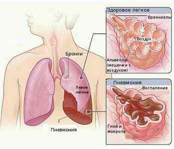 Развитие пневмонии у детей до 1 года