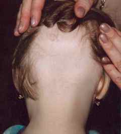 Почему лезут волосы у ребенка 2 года